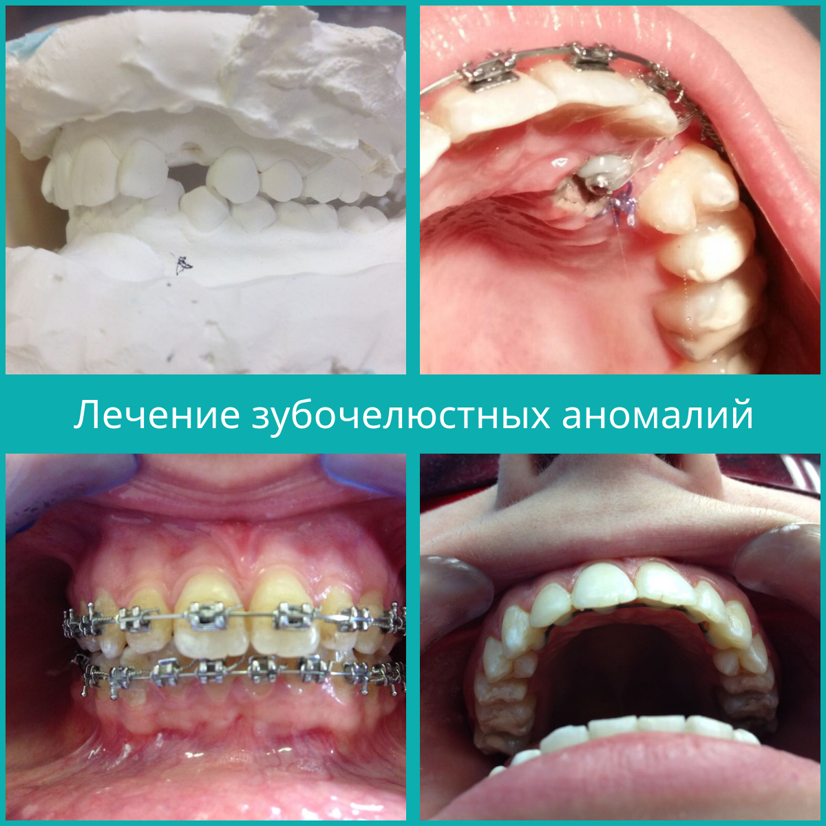 Исправление прикуса Томск Алеутский 1-й стоматология мила дент томск